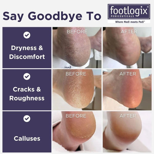 Footlogix Foot Care Callus Softener Combo - Callus Remover Spray & Double-Sided Foot File for Dry, Cracked Heels, Pedicure Tools for Feet, Foot Exfoliator