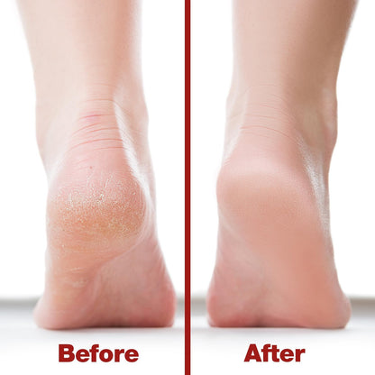 Probelle Double Sided Multidirectional Nickel Foot File Callus Remover - Immediately Reduces calluses and Corns to Powder for Instant Results, Safe Tool (Dark Grey)