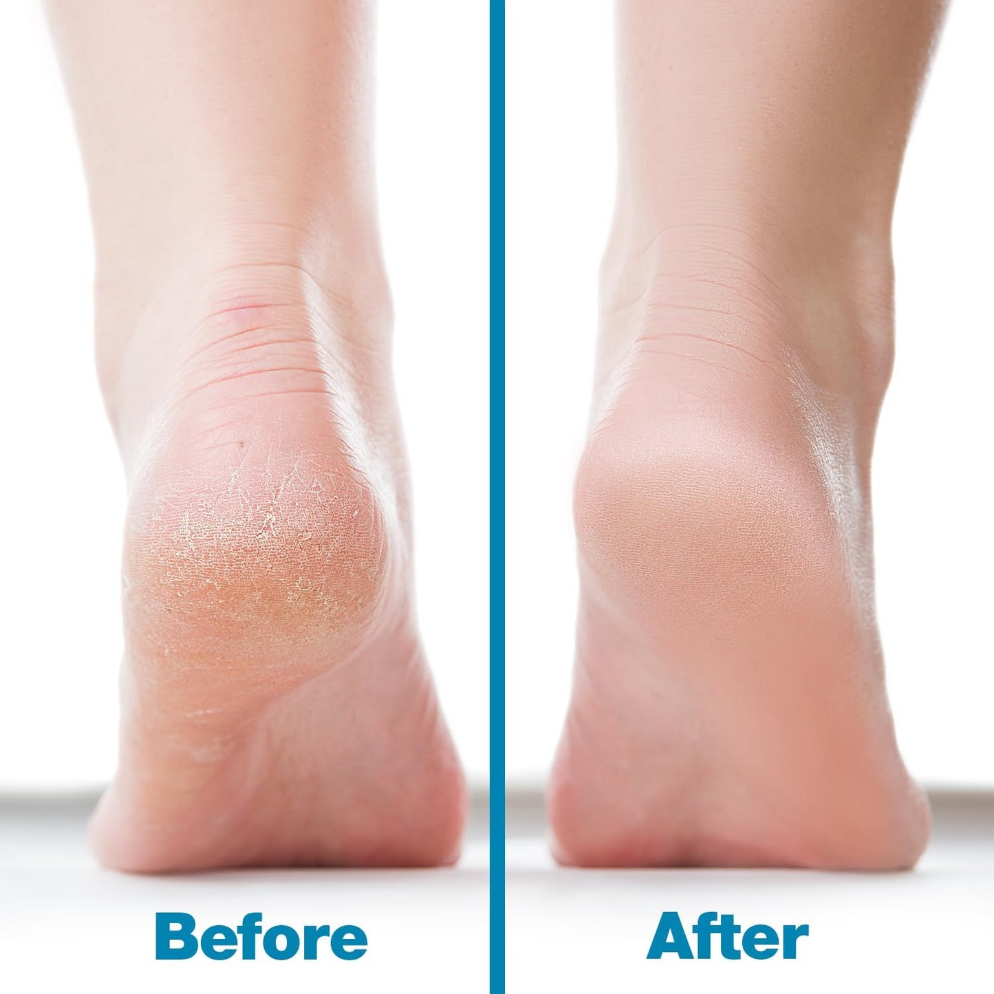 Probelle Double Sided Multidirectional Nickel Foot File Callus Remover - Immediately Reduces calluses and Corns to Powder for Instant Results, Safe Tool (Dark Grey)