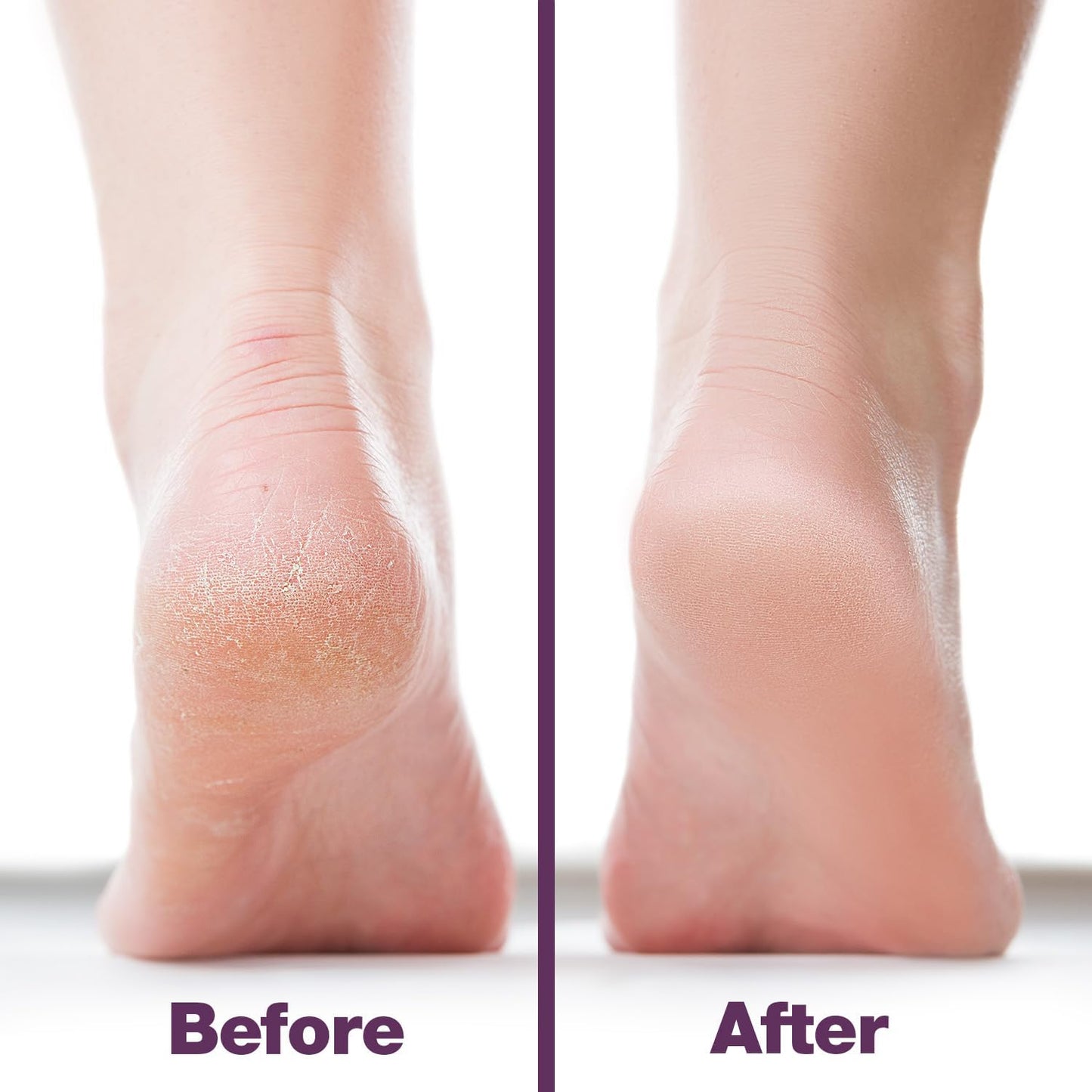 Probelle Double Sided Multidirectional Nickel Foot File Callus Remover - Immediately Reduces calluses and Corns to Powder for Instant Results, Safe Tool (Dark Grey)