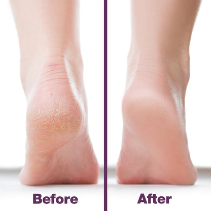 Probelle Double Sided Multidirectional Nickel Foot File Callus Remover - Immediately Reduces calluses and Corns to Powder for Instant Results, Safe Tool (Dark Grey)
