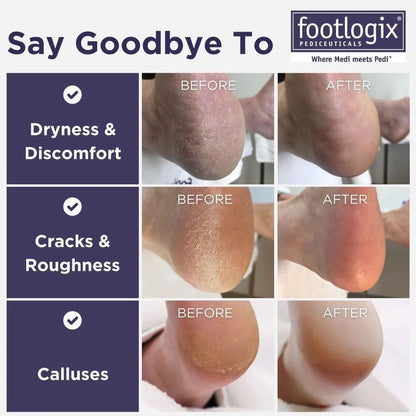 Footlogix Foot Care Callus Softener Combo - Callus Remover Spray & Double-Sided Foot File for Dry, Cracked Heels, Pedicure Tools for Feet, Foot Exfoliator