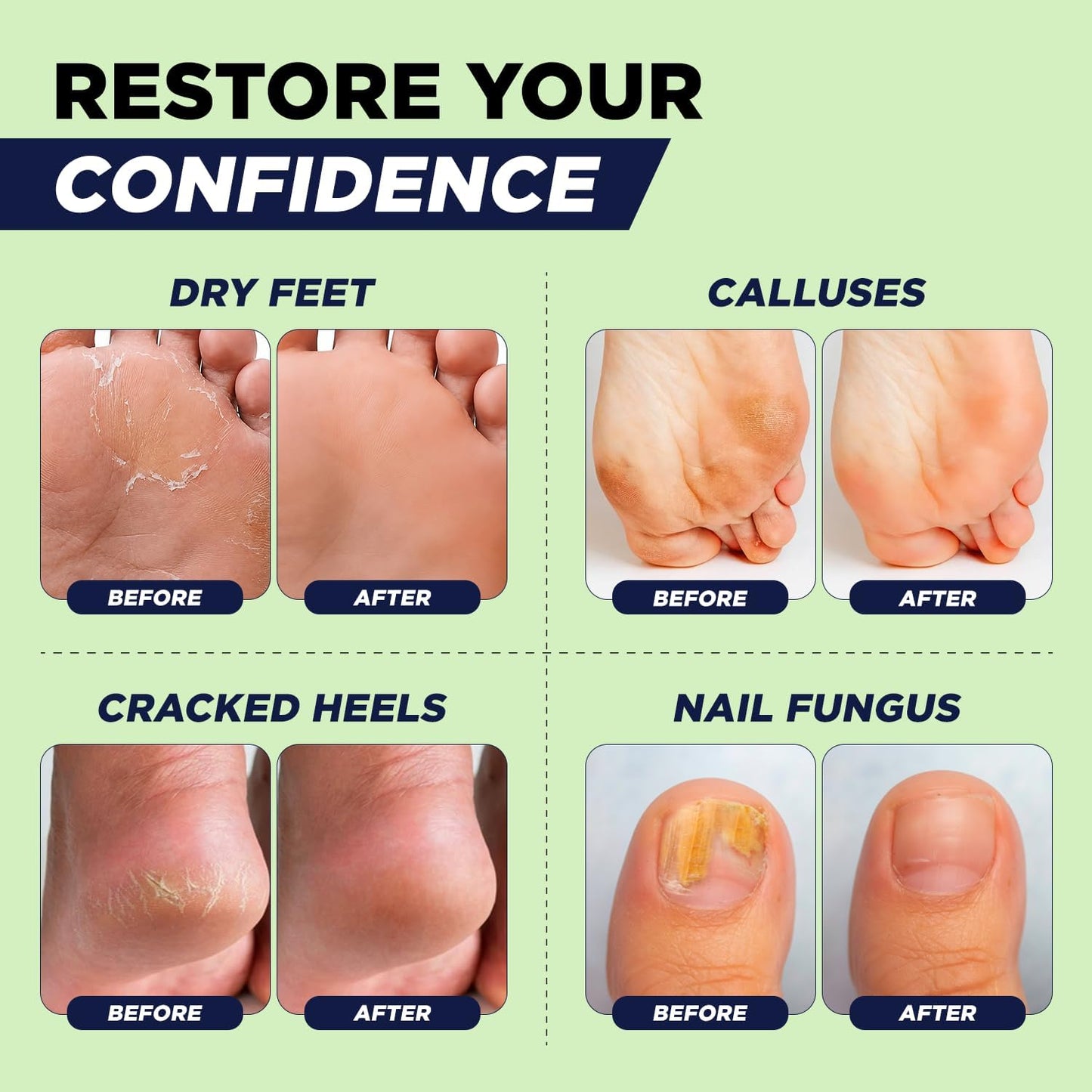 FOOT CURE Tea Tree Oil Foot Soak with Epsom Salt - Best Toenail Fungus Treatment, Athletes Foot & Softens Calluses - Soothes Sore & Tired Feet, Fungal Toe, Foot Odor Scent, Spa Pedicure (Pack of 2)