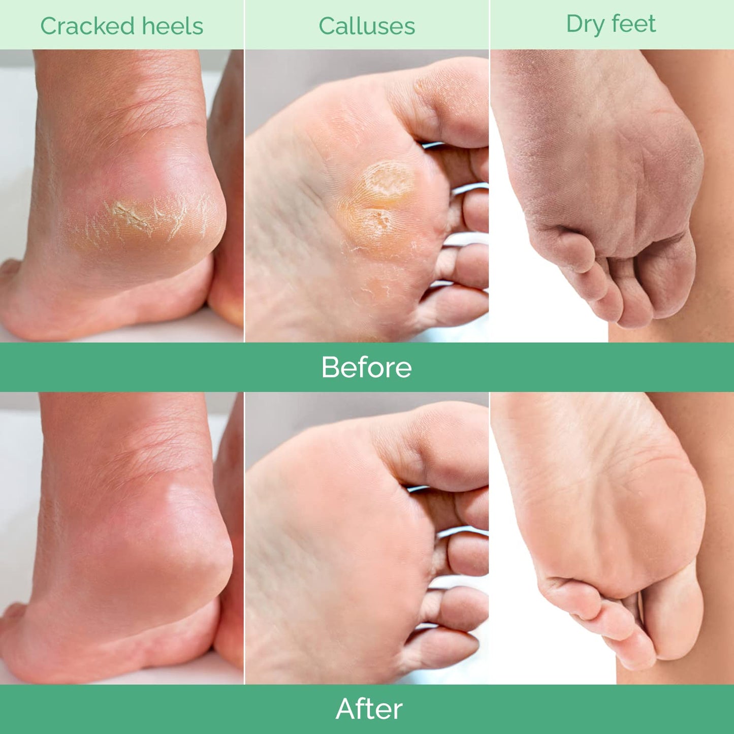 PLANTIFIQUE Foot Peeling Mask 1 Pack | Dermatologically Tested Repairs Heels & Removes Dry Dead Skin for Baby Soft Feet | Exfoliating Foot Peel Mask for Dry Cracked Feet | Peach