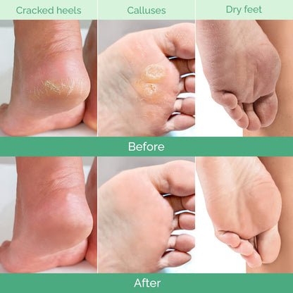 PLANTIFIQUE Foot Peeling Mask 1 Pack | Dermatologically Tested Repairs Heels & Removes Dry Dead Skin for Baby Soft Feet | Exfoliating Foot Peel Mask for Dry Cracked Feet | Peach