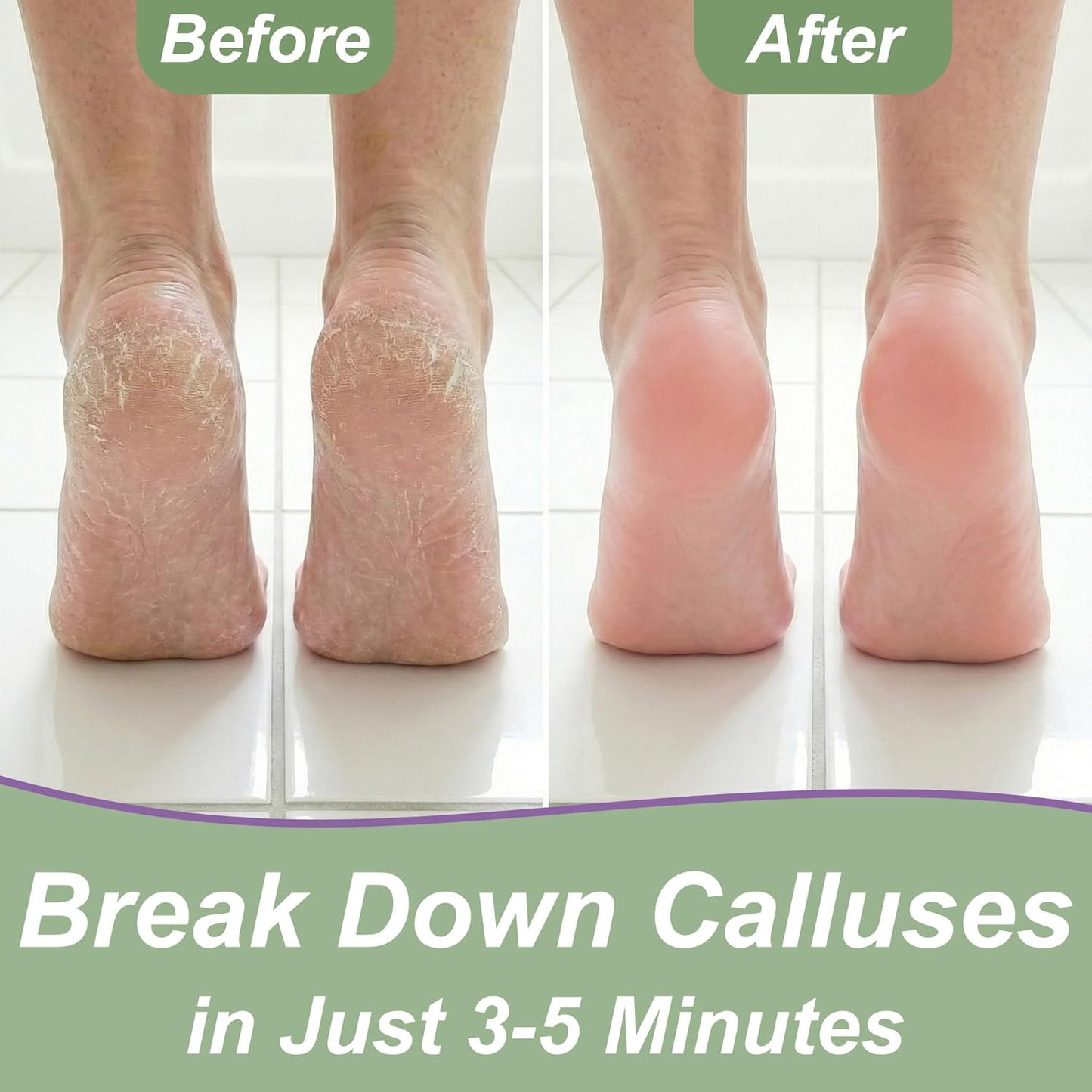 Dr. Entre's Callus Remover Gel Kit for Feet: Foot File, Pumice Stone, 5 Glove Pairs for Gel Application, Spa Kit, Foot Care, Pedicure Tools, Scrubber, 8oz