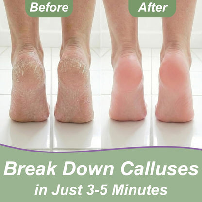 Dr. Entre's Callus Remover Gel Kit for Feet: Foot File, Pumice Stone, 5 Glove Pairs for Gel Application, Spa Kit, Foot Care, Pedicure Tools, Scrubber, 8oz