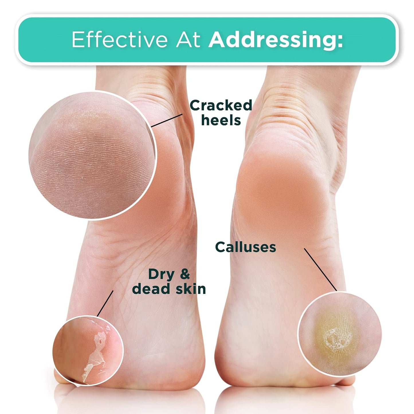 DERMORA Foot Peel Mask - Exfoliating Foot Peeling Mask for Dry, Cracked Feet, At-Home Spa Care, Callus Removal & Smoother Skin Result, 2 Pairs Regular Size (Fits up to Woman 11, Men 10) Original Scent