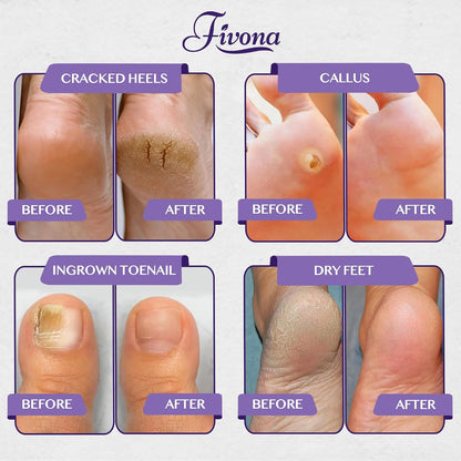 Fivona Tea Tree Foot Soak Blend 14.1 oz - Epsom Salt with Essential Oils for Healthy Toenails, Soothing Relief, Callus Softening - Pedicure Therapy for Soft, Rejuvenated Feet