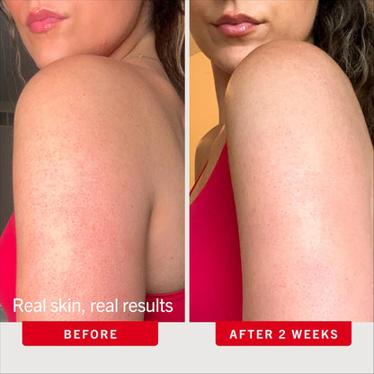 First Aid Beauty KP Bump Eraser Body Scrub with 10% AHA - Dermatologist-Tested Keratosis Pilaris Exfoliator - Support for Rough Bumps, Uneven Skin Texture & Strawberry Skin - Sensitive Skin