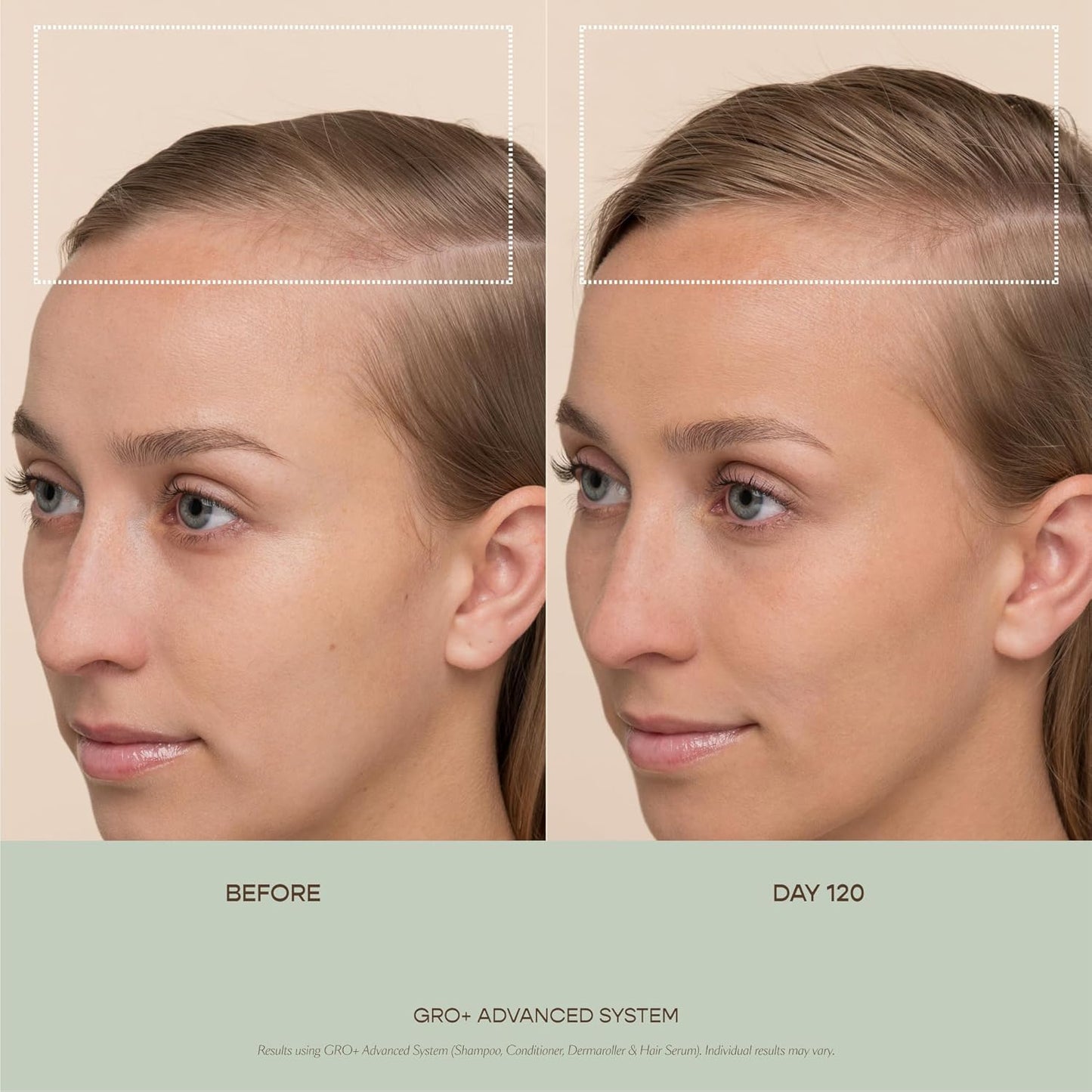 VEGAMOUR GRO+ Advanced Dermaroller for the Scalp, Gently Exfoliates to Help Promote Hair Density, Fuller Looking Hair with Continued Use