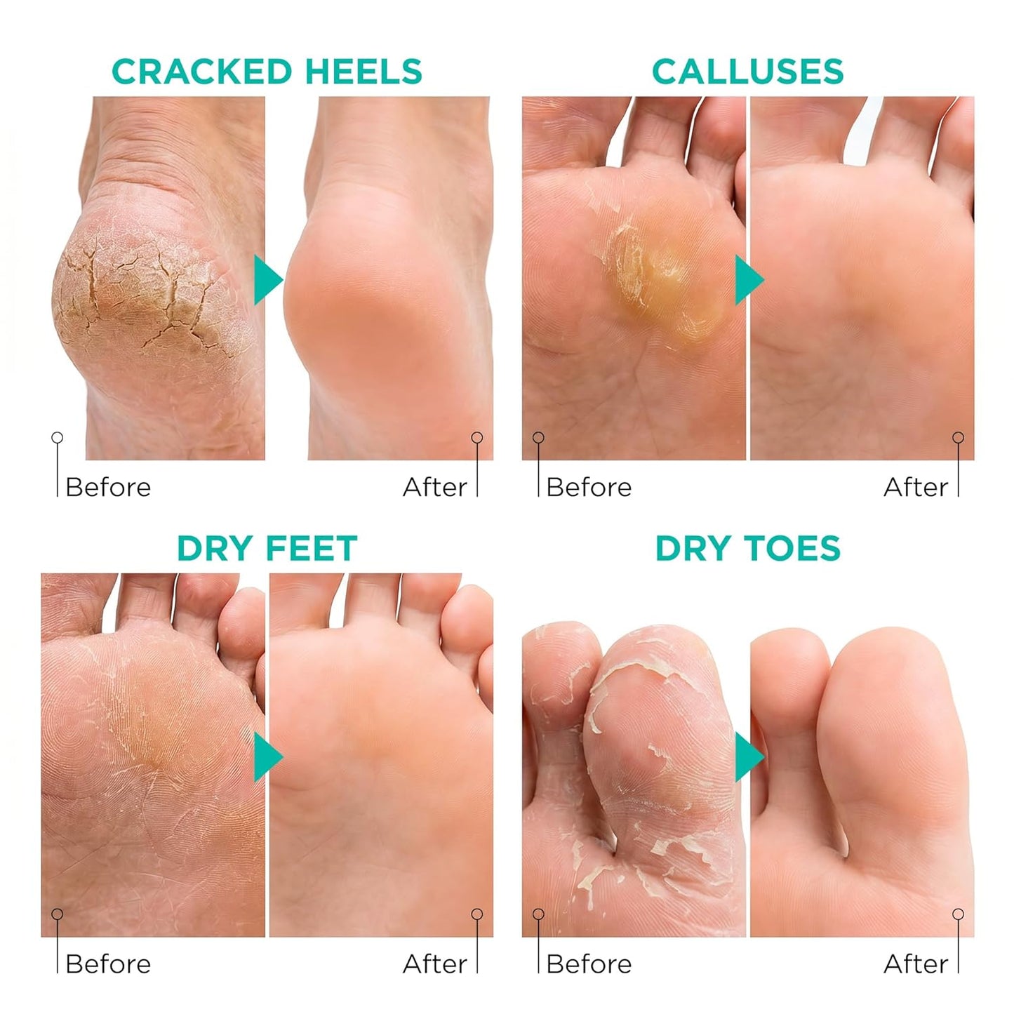 Lavinso Foot Peel Mask for Dry Cracked Feet – 2 Pack Peeling Mask Removes Dead Skin and Calluses - Exfoliating for Soft Baby Feet, Original Scent